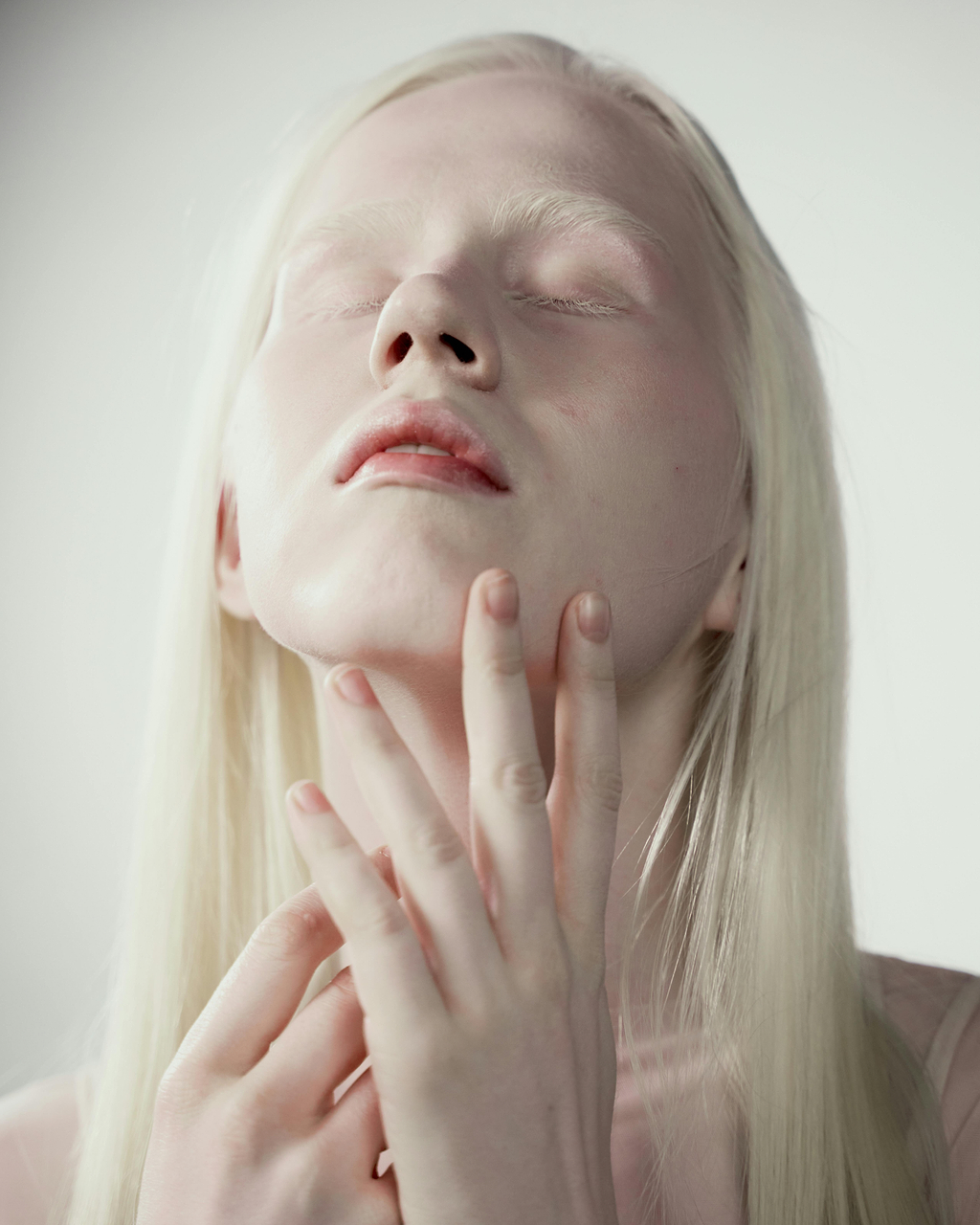 Différences vitiligo et albinisme partiel