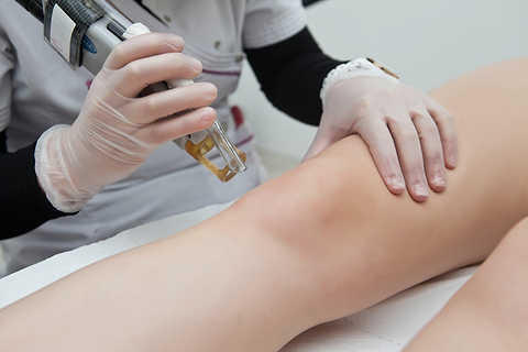 Idées reçues sur l'épilation définitive au laser.