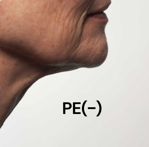 Typologie de peau PE(-).