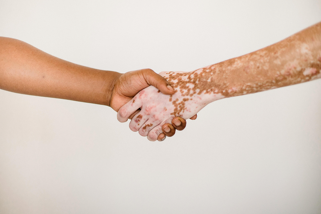 Le vitiligo associé à la perte de cheveux.