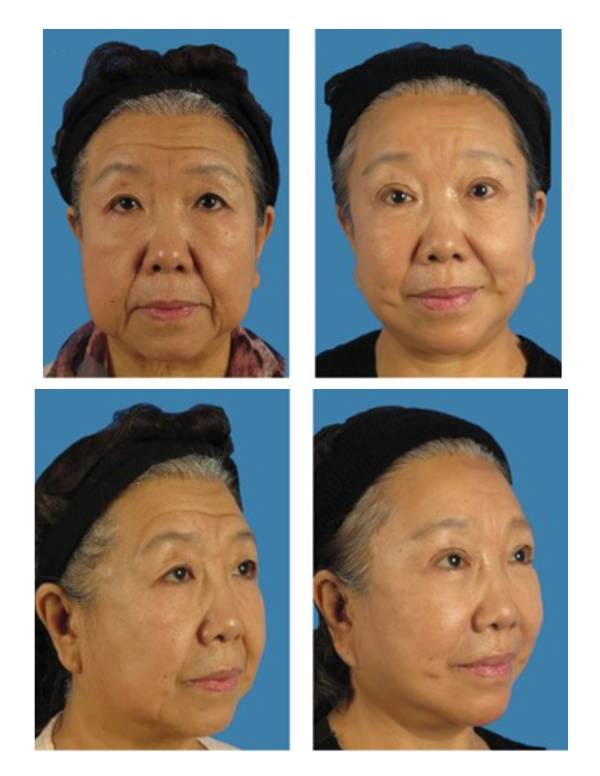 Avant/après lifting du visage.