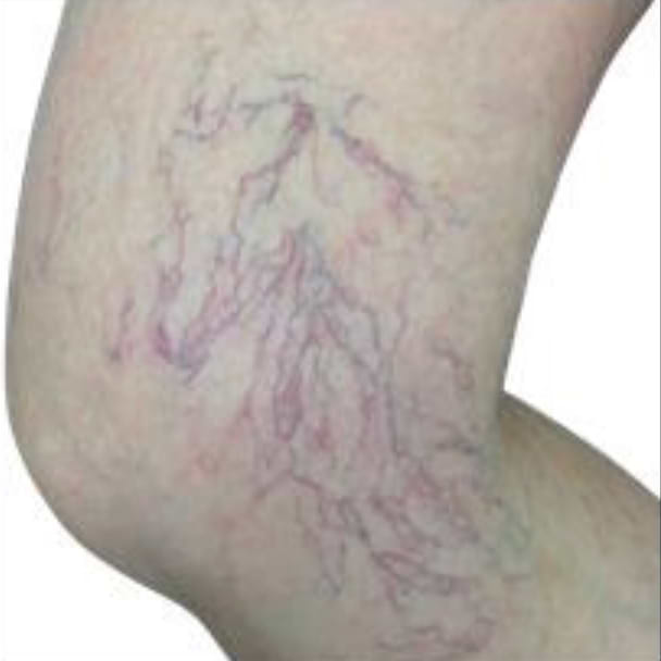 Telangiectasia.