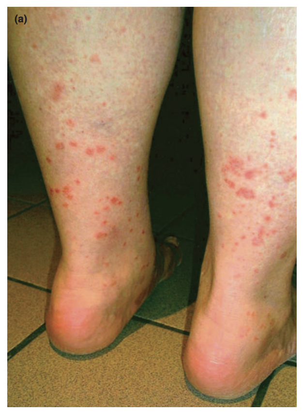 Pétéchies sur les jambes liées à une exposition solaire.