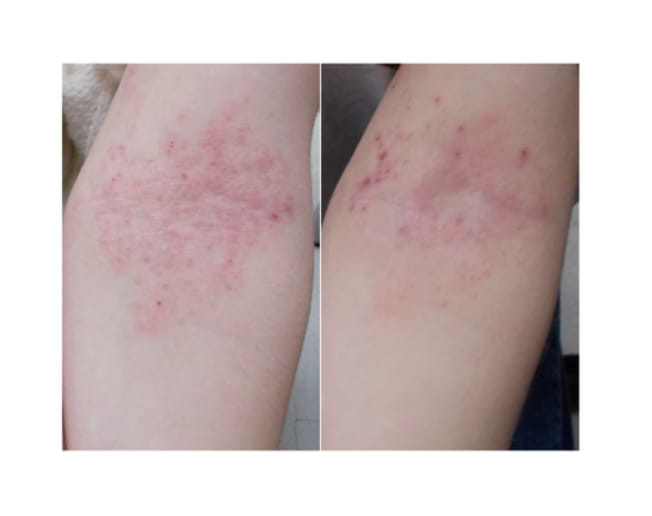 Rougeurs dues à une irritation.