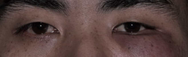 Poches sous les yeux dues à inflammation et photosensibilité lupus.