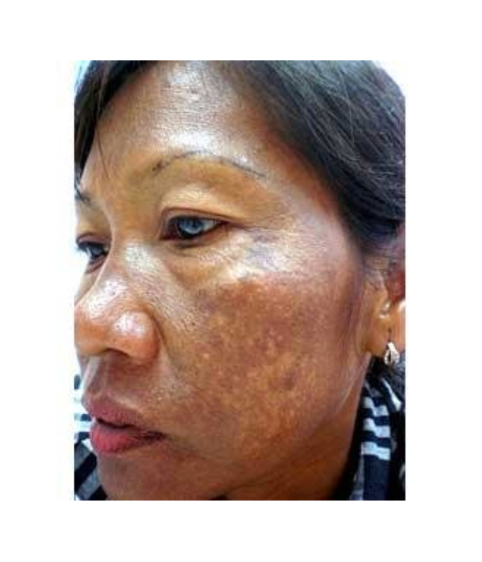 Cas d'ochronose causé par une utilisation prolongée d'hydroquinone.
