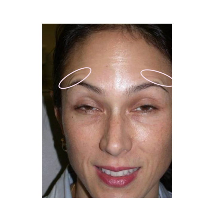 Échec suite à une injection de botox, résultant en des sourcils "en virgule".