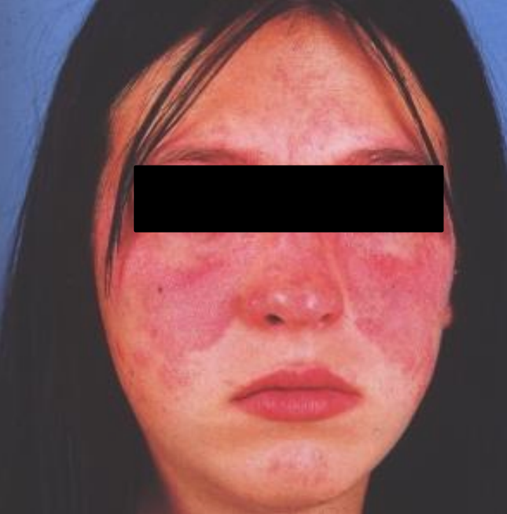 Lupus érythémateux systémique.