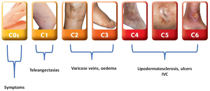 Classification CEAP varices.