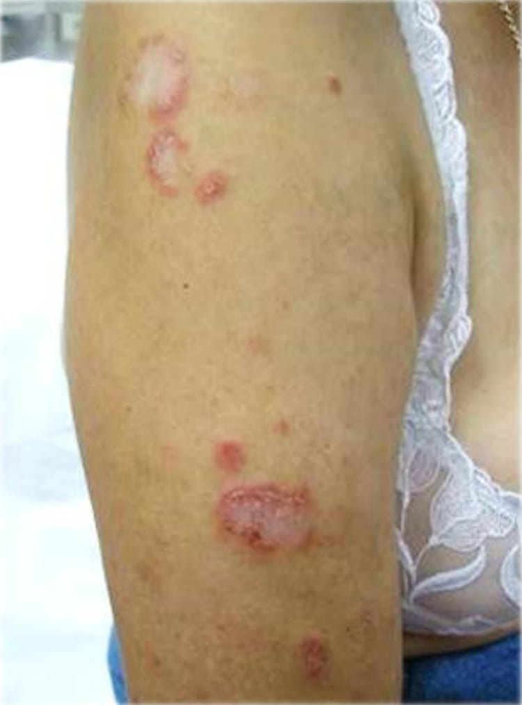 Lupus cutané subaigu.