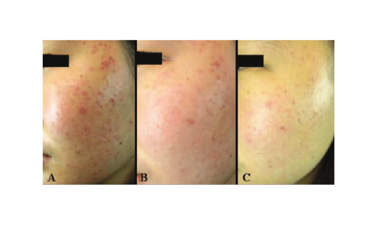 Érythème post-inflammatoire initial (A) et évolution après une (B) et deux (C) séances de lumière pulsée.