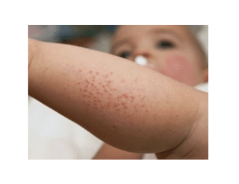 Boutons dus à une allergie aux œufs.