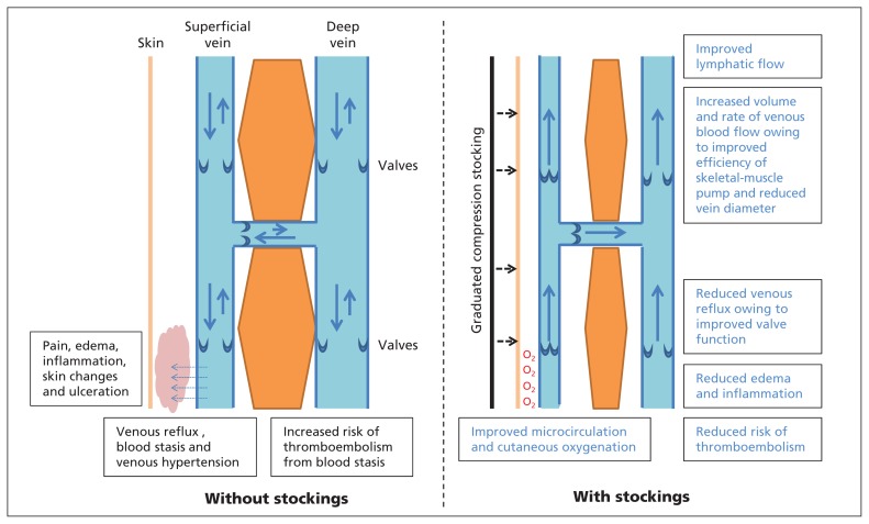 How compression stockings work.