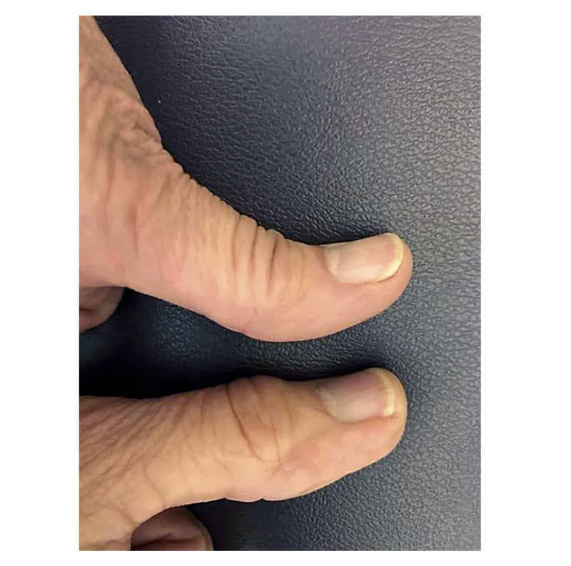 Pouce droit avec une callosité comparé au pouce gauche sans.