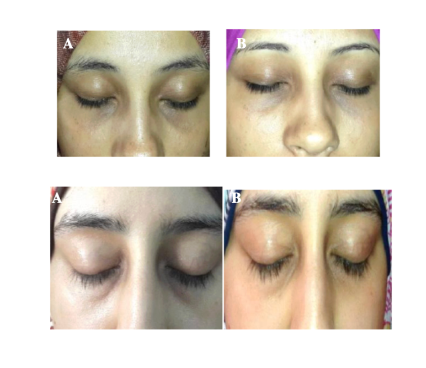 Avant/après peeling du contour des yeux pour deux participantes.