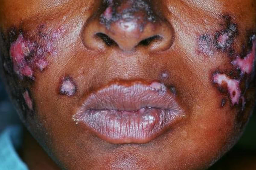 Lupus érythémateux discoïde.