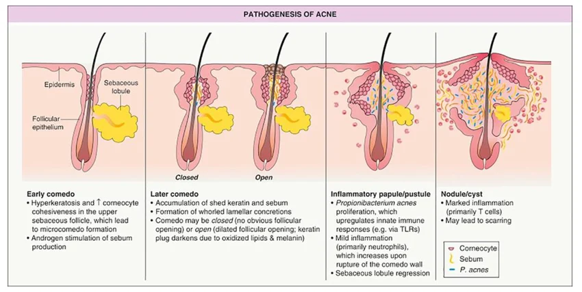 La pathogenèse de l'acné.