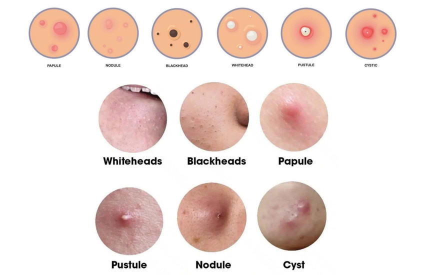 Les différentes lésions d'acné.