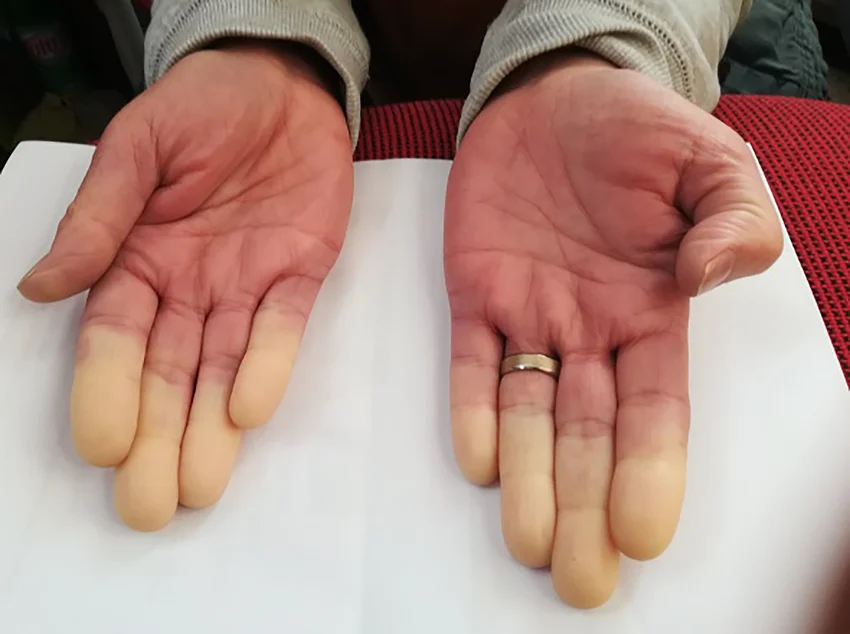 Le phénomène de Raynaud.