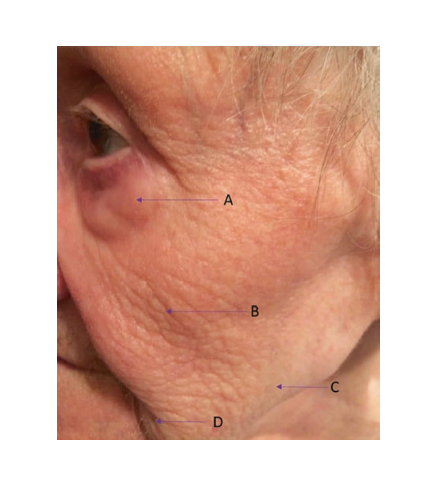 Peau d'une femme de 95 ans. (A) contour des yeux ; (B) élastose ; (C) ptose ; (D) poils indésirables.