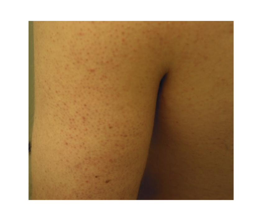 Présentation de la kératose pilaire (papules folliculaires kératosiques, discrètes et asymptomatiques avec un érythème périfolliculaire).