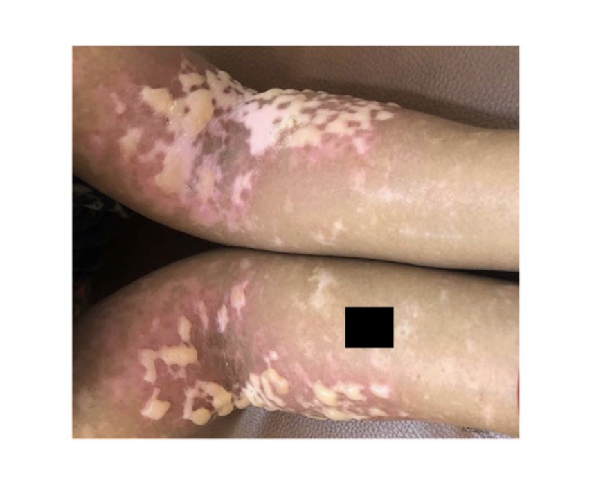 Réaction cutanée sur des plaques de vitiligo chez une femme de 36 ans après application d’un mélange d’huile de coco et de graines de bakuchi, suivie d’une exposition au soleil.