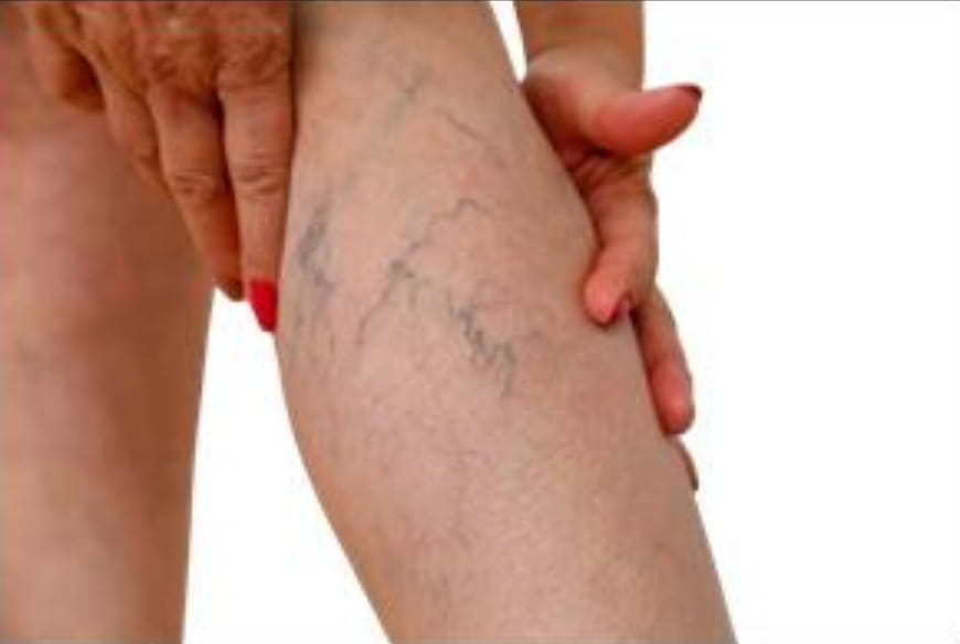 Reticular veins.