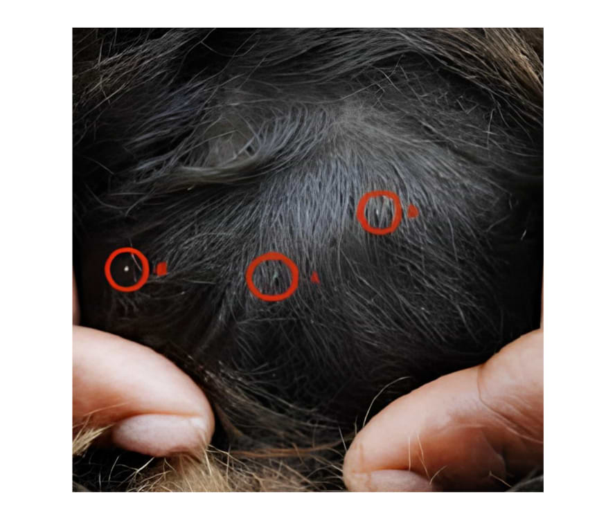 Examen des cheveux d’un individu contenant à la fois des poux adultes et des œufs.