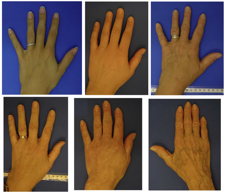 Évolution des mains au fil du temps (de gauche à droite et de haut en bas : main d'une femme de 30 ans, de 40 ans, de 50 ans, de 60 ans, de 70 ans et de 80 ans).
