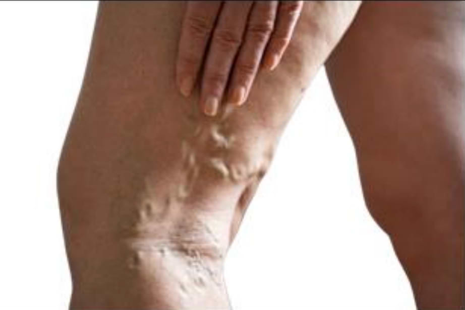 Trunk Varicose Veins.