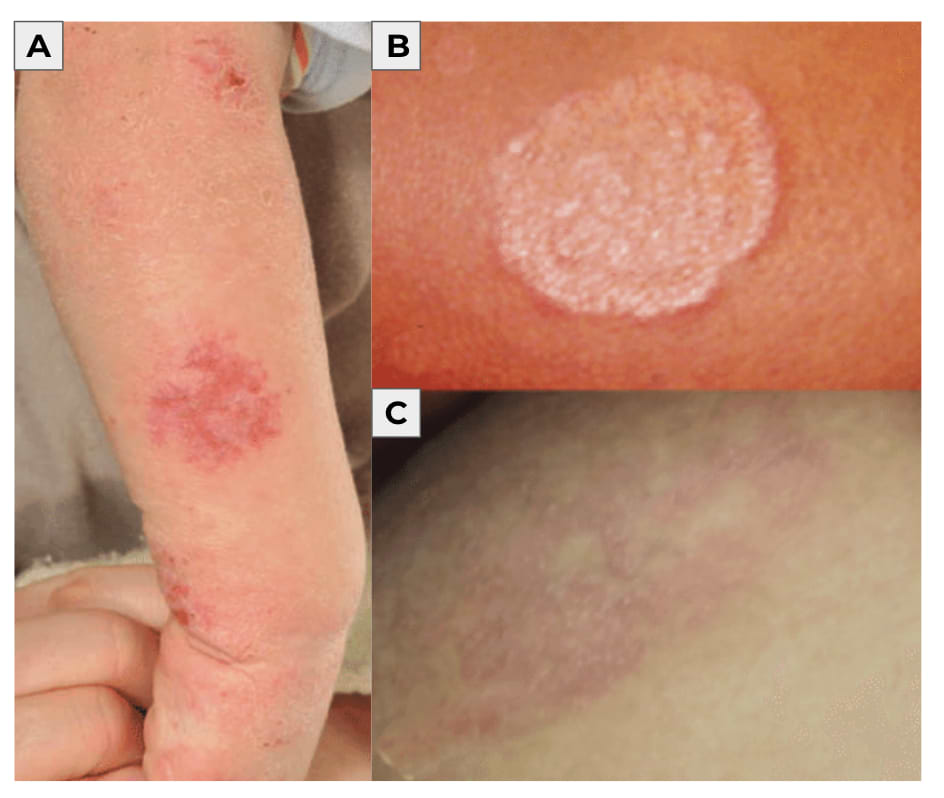 Manifestations cliniques de l'eczéma (A) et de la mycose (B et C).