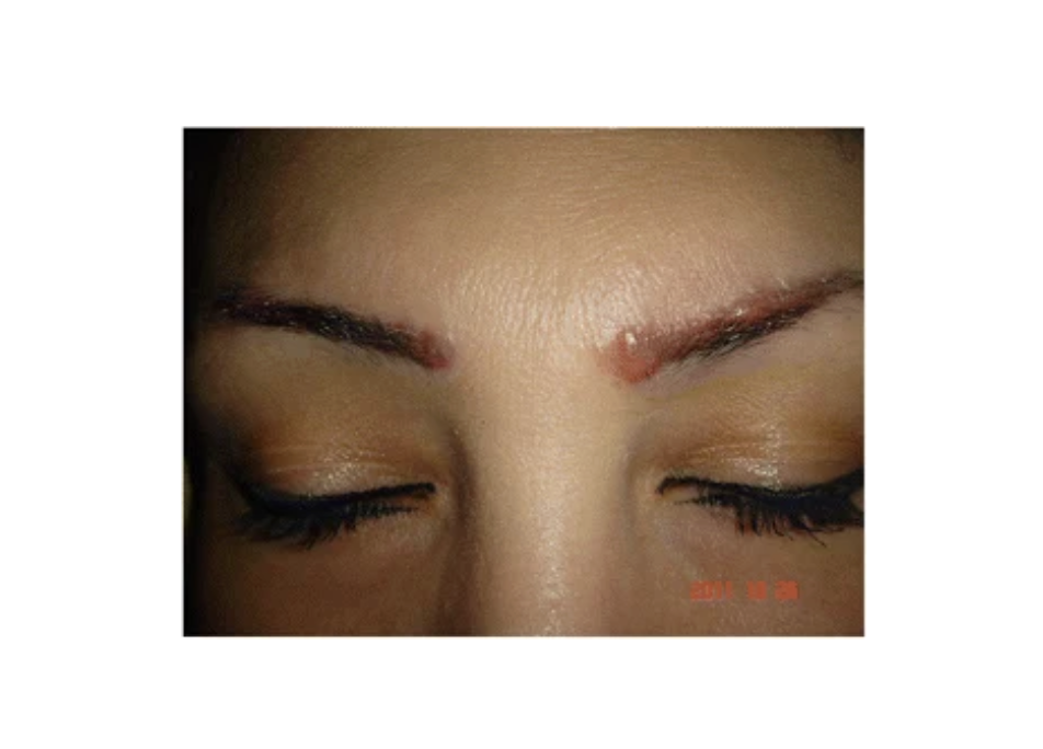 Complications suite à un tatouage cosmétique des sourcils (réaction granulomateuse).