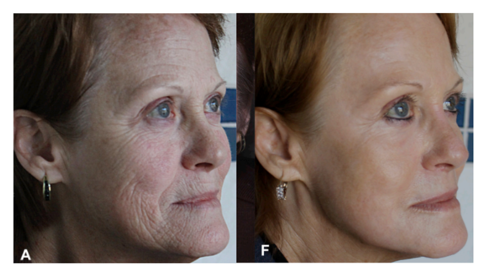 Peeling profond au phénol : avant/après à 12 mois.