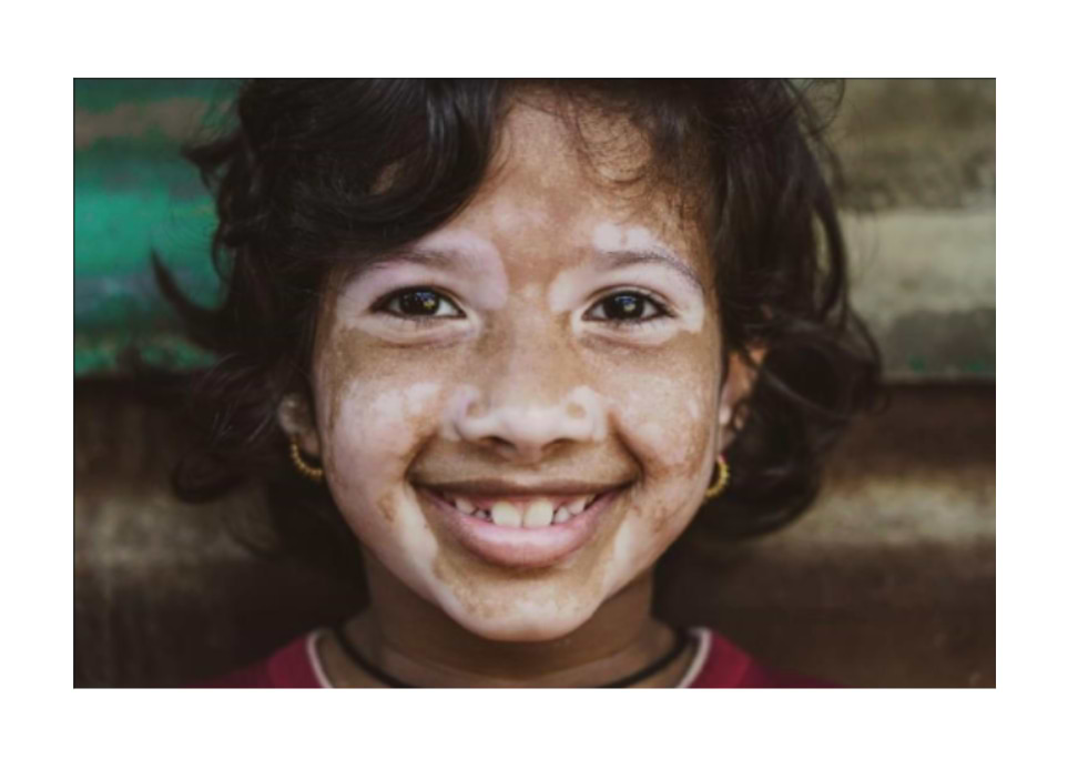 Signes du vitiligo sur le visage (vitiligo acrofacial).