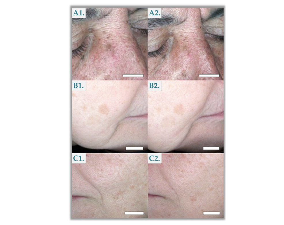 Évolution de l’hyperpigmentation chez trois individus après l’application régulière de soins contenant de l’acide tranéxamique.