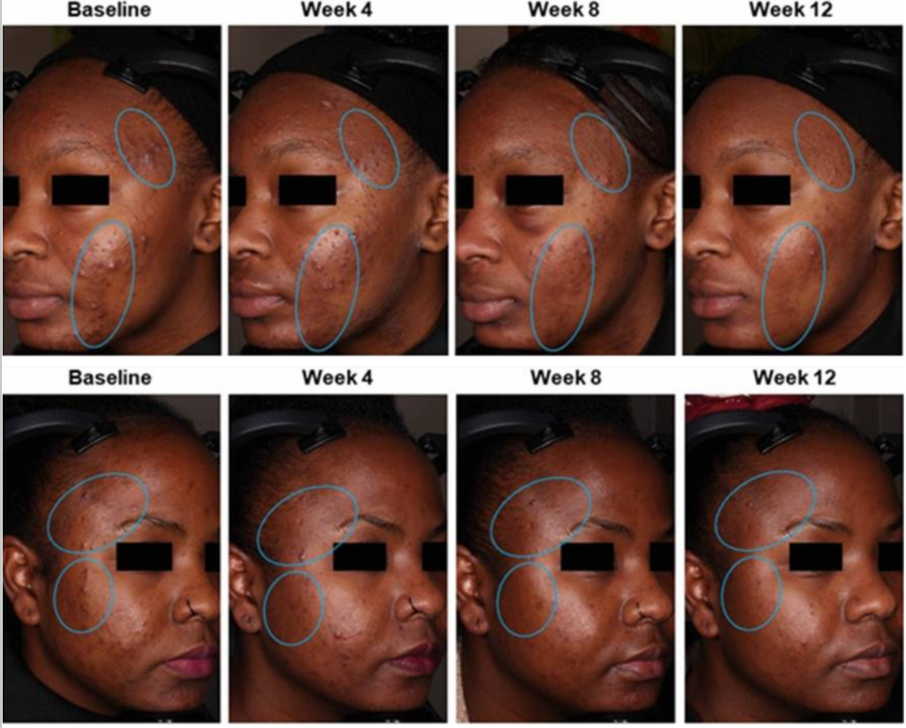 Effet d'une lotion à 0,045% de tazarotène sur deux femmes souffrant d'acné et d'hyperpigmentation.
