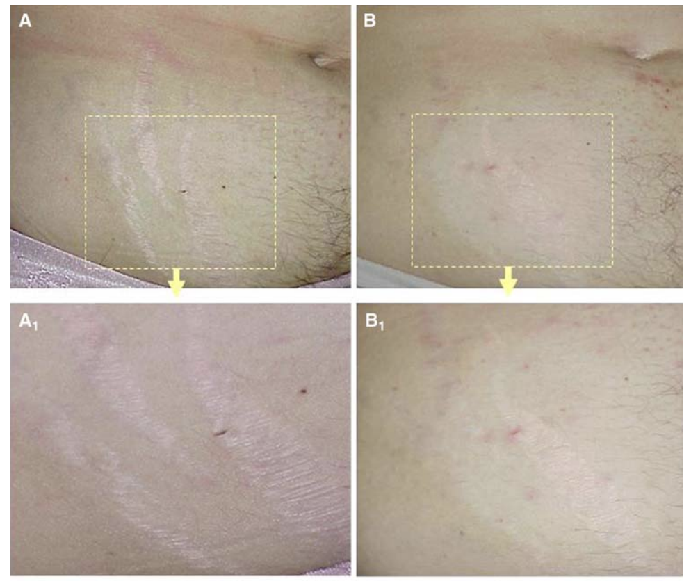 Effets de la lumière infrarouge sur les vergetures d'un patient.