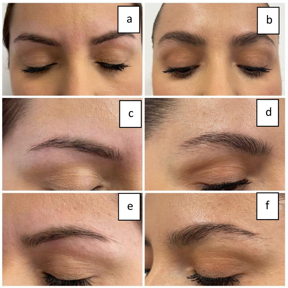 Avant/après pour une participante. Les figures a, c et e représentent la ligne de sourcils avant la première session de mésothérapie et les figures b, d et f représentent le résultat après.