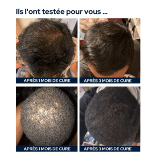 Hair Loss Cure for Men 1 Month