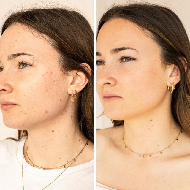 Anti-Blemish Serum