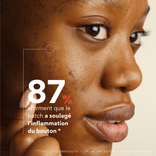 Acne Pimple Patches 3