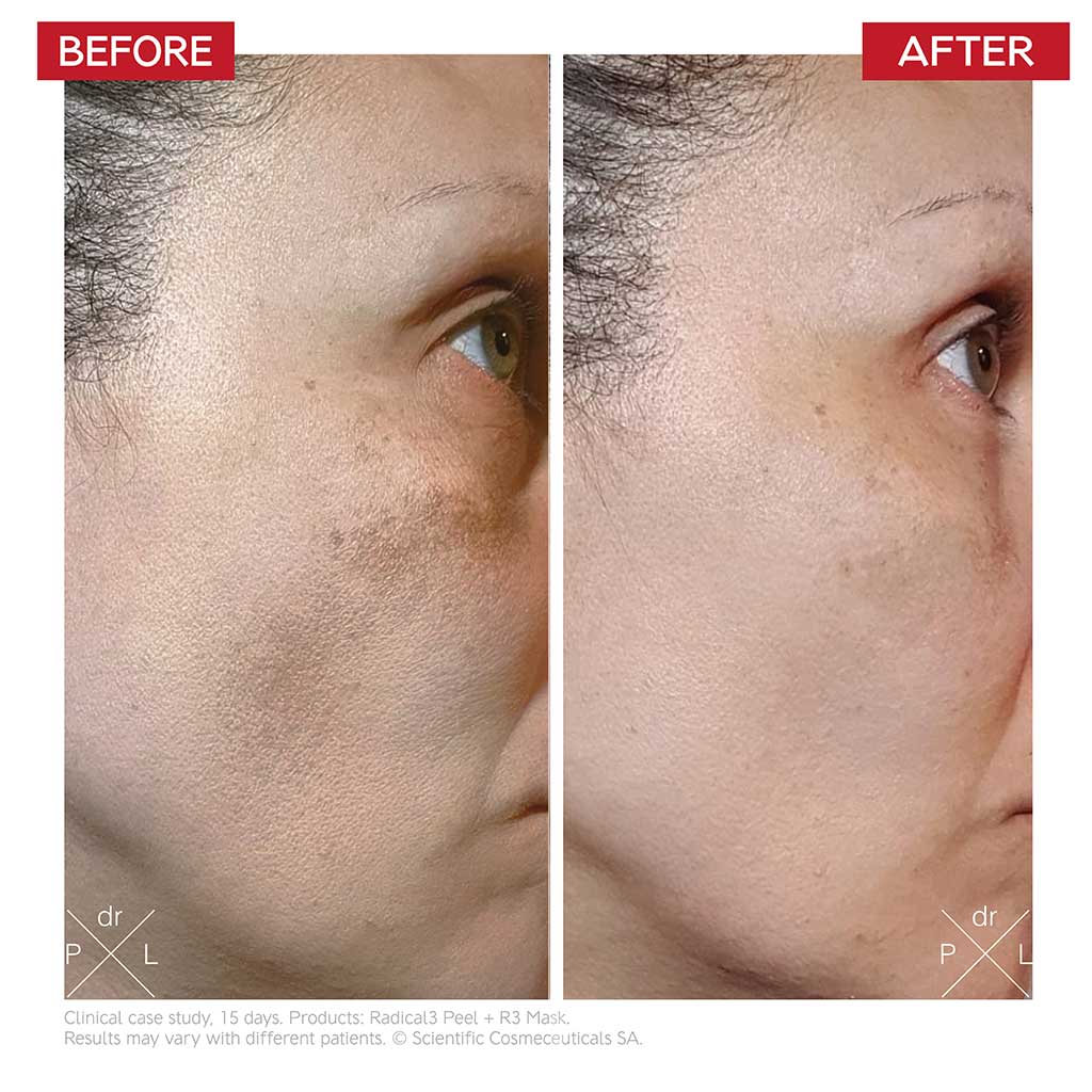 Dr.Levy Radical 3 Face Peeling 50ml - DR. LEVY - Duty Free