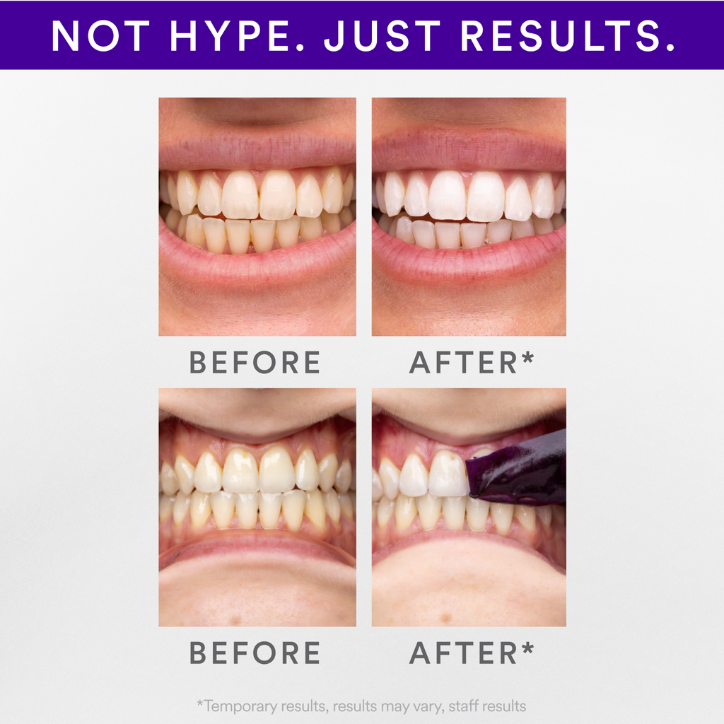 Hismile V34 Teeth Whitening Strips 14unit - HISMILE - Duty Free
